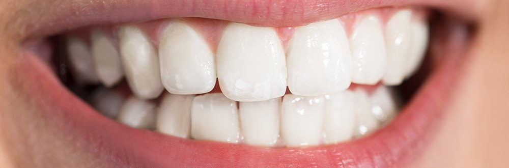 After professional whitening