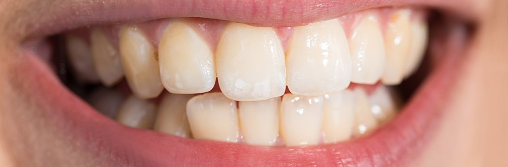 Before whitening